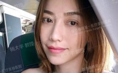 杨大平：小切口MACS提升术后40天，美成仙!