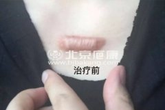 疤痕故事：希望北京疤康对得起你的千里迢迢