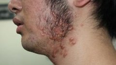 小伙疤痕疙瘩毁容被说骂“怪物”  在北京疤康重获自