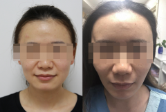 毕业季整容热，学生求美需谨慎！