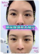 北京伊美尔：玻尿酸品牌十大排行榜