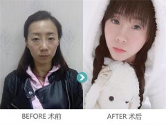 熊宜文【长沙贝美真人秀108例】她去做了全脸脂肪填充