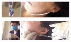 北京伊美尔：保妥适打全脸，僵脸和紧致只差一个度