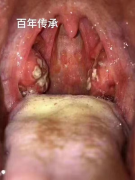 十年慢性咽炎好了,高兴的来分享给大家